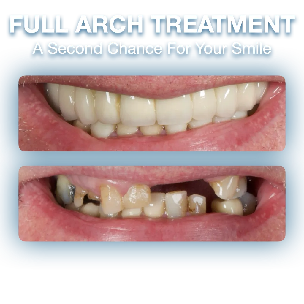 all on 6 full arch rehabilitation