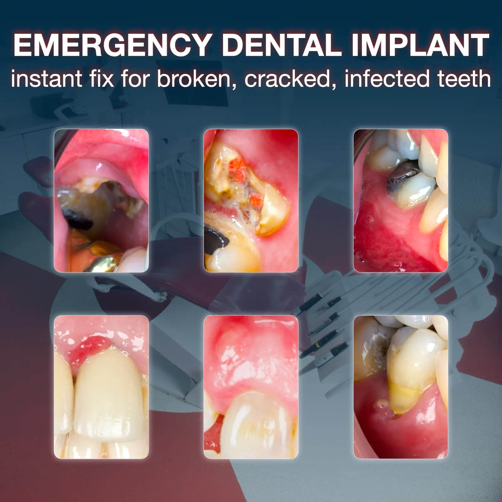 Tooth emergencies fixed by implants