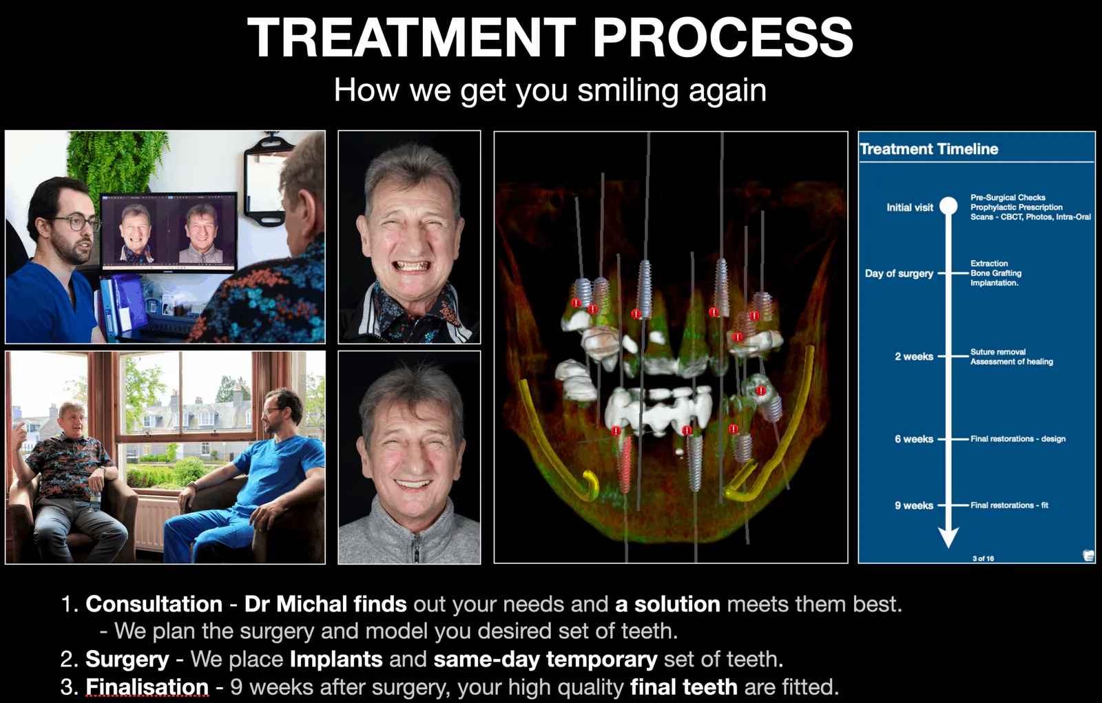 full arch treatment process explained Dr michal nohawica